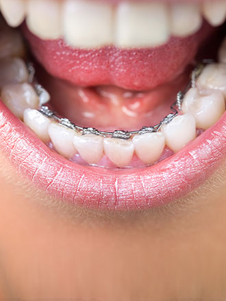 inbrace lingual braces