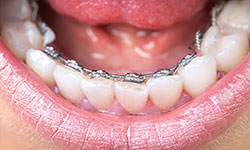 lingual braces